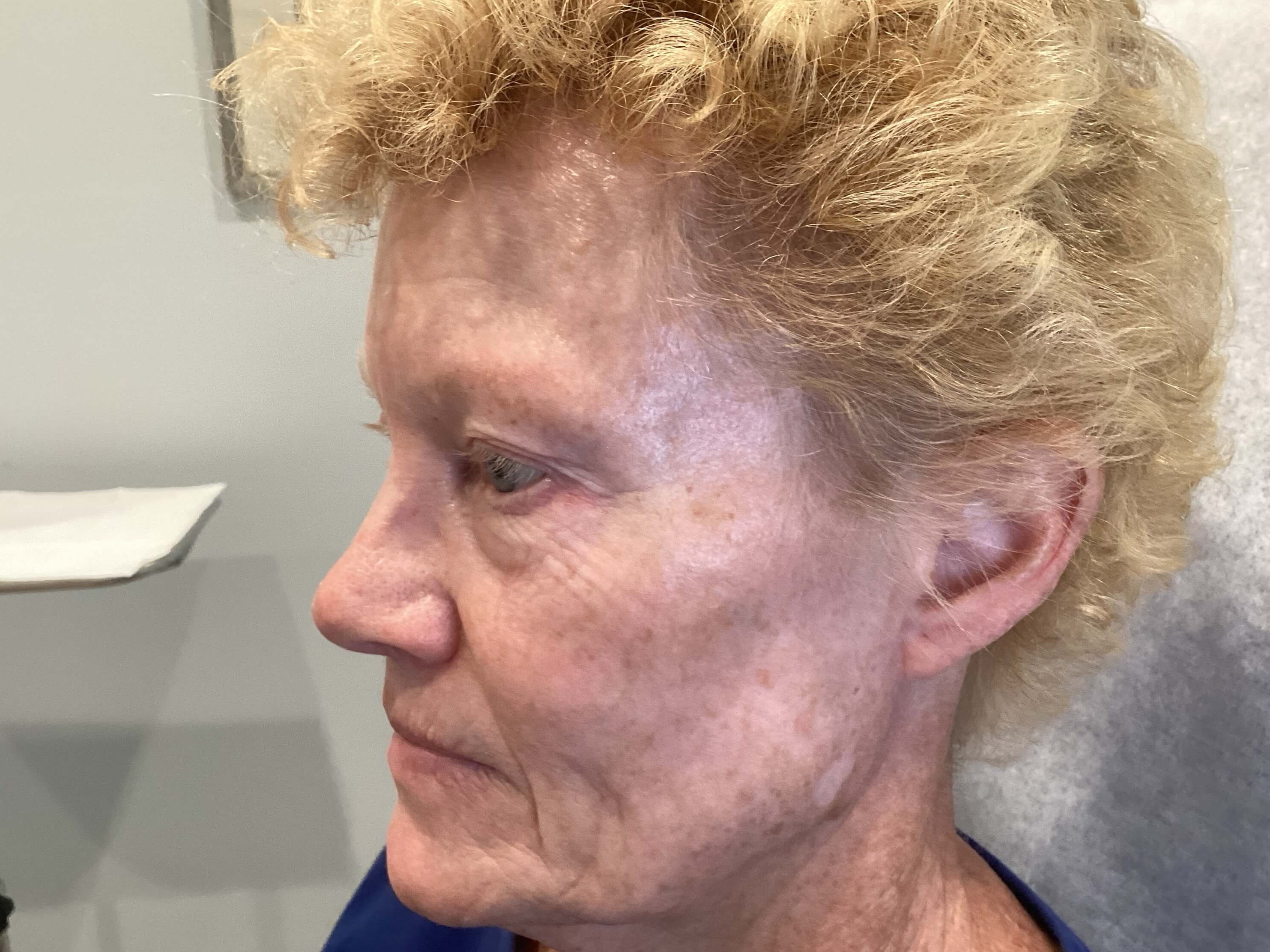 IPL Photofacial After