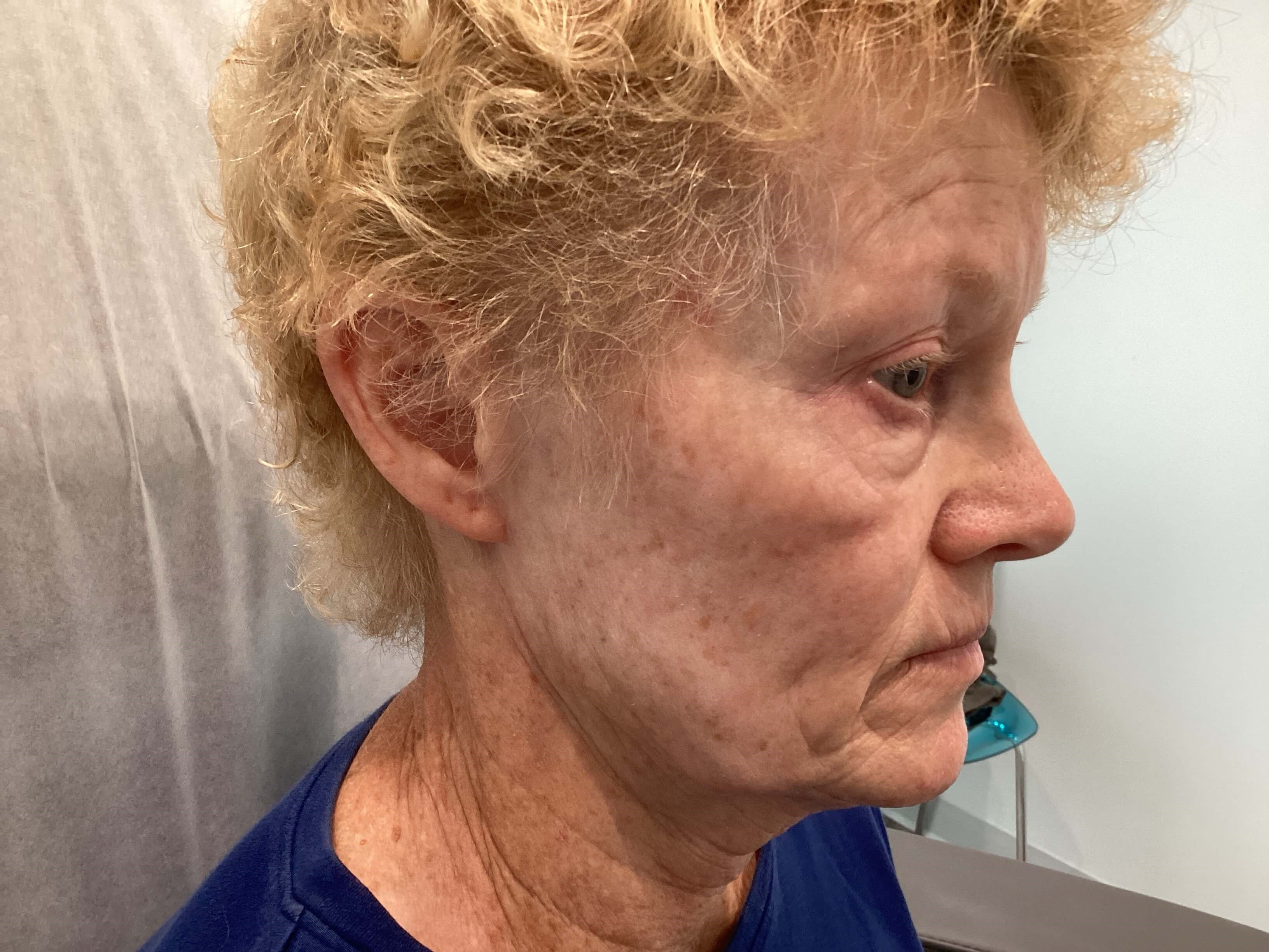 IPL Photofacial Before