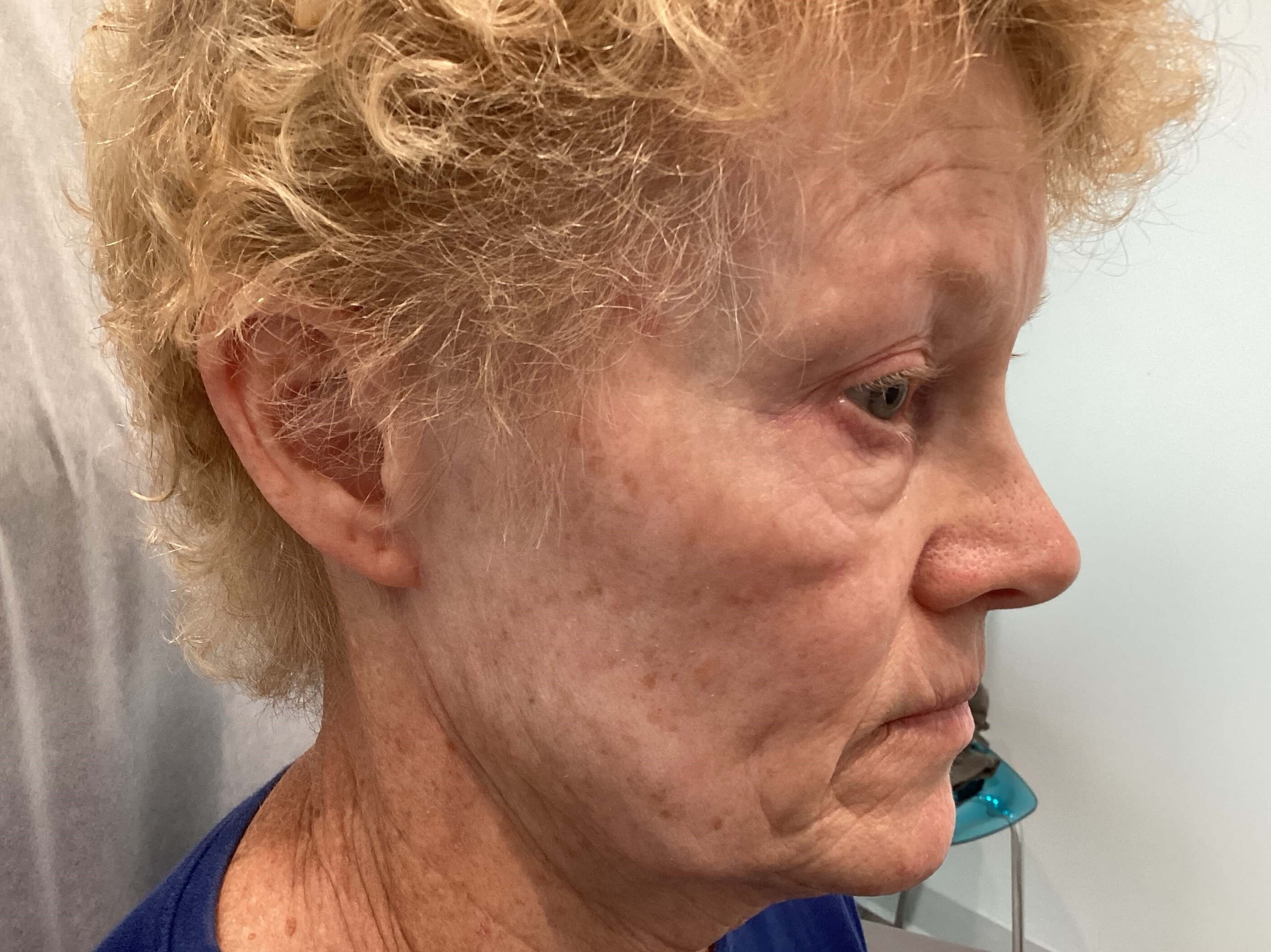 IPL Photofacial Before