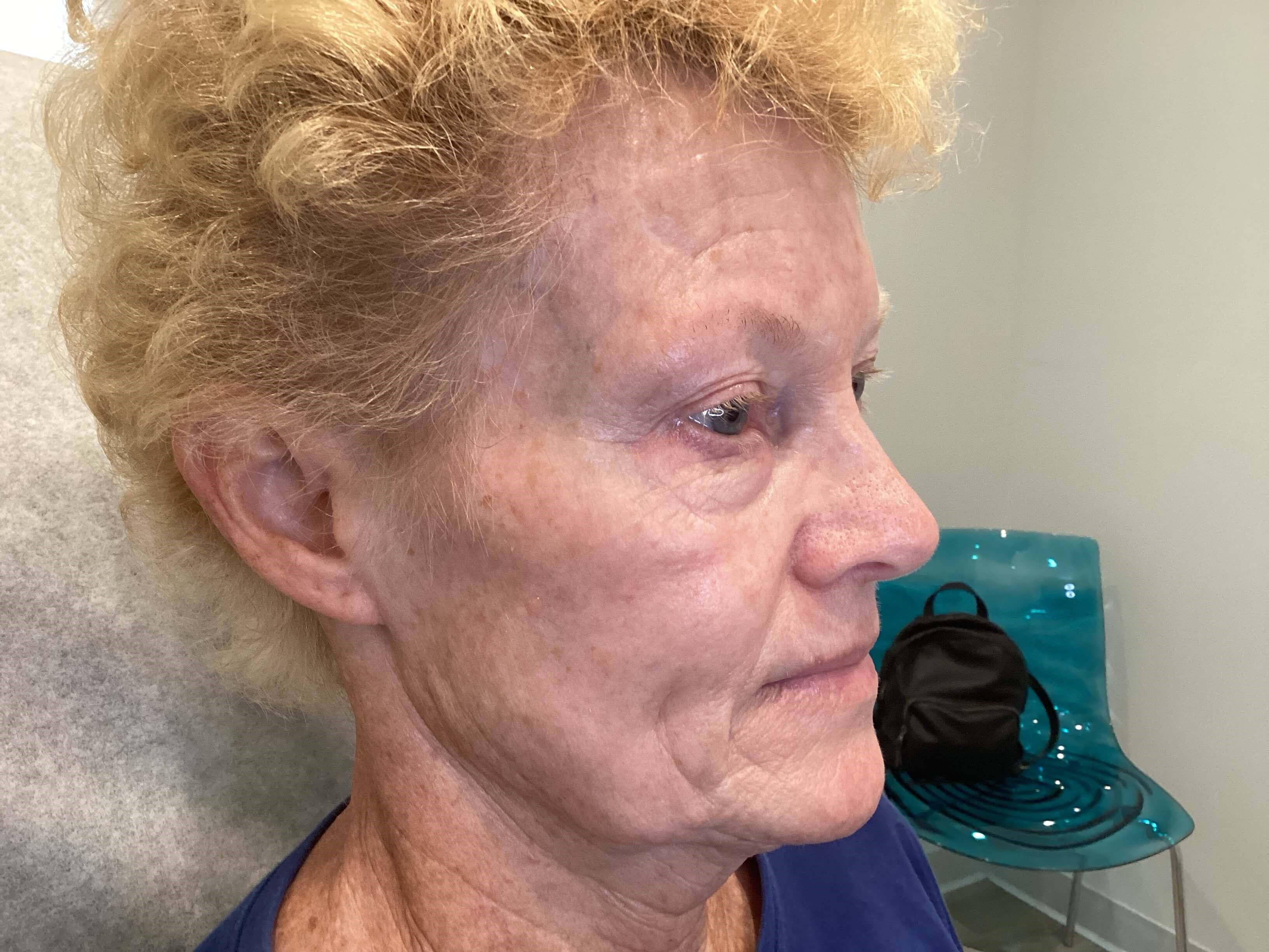IPL Photofacial After