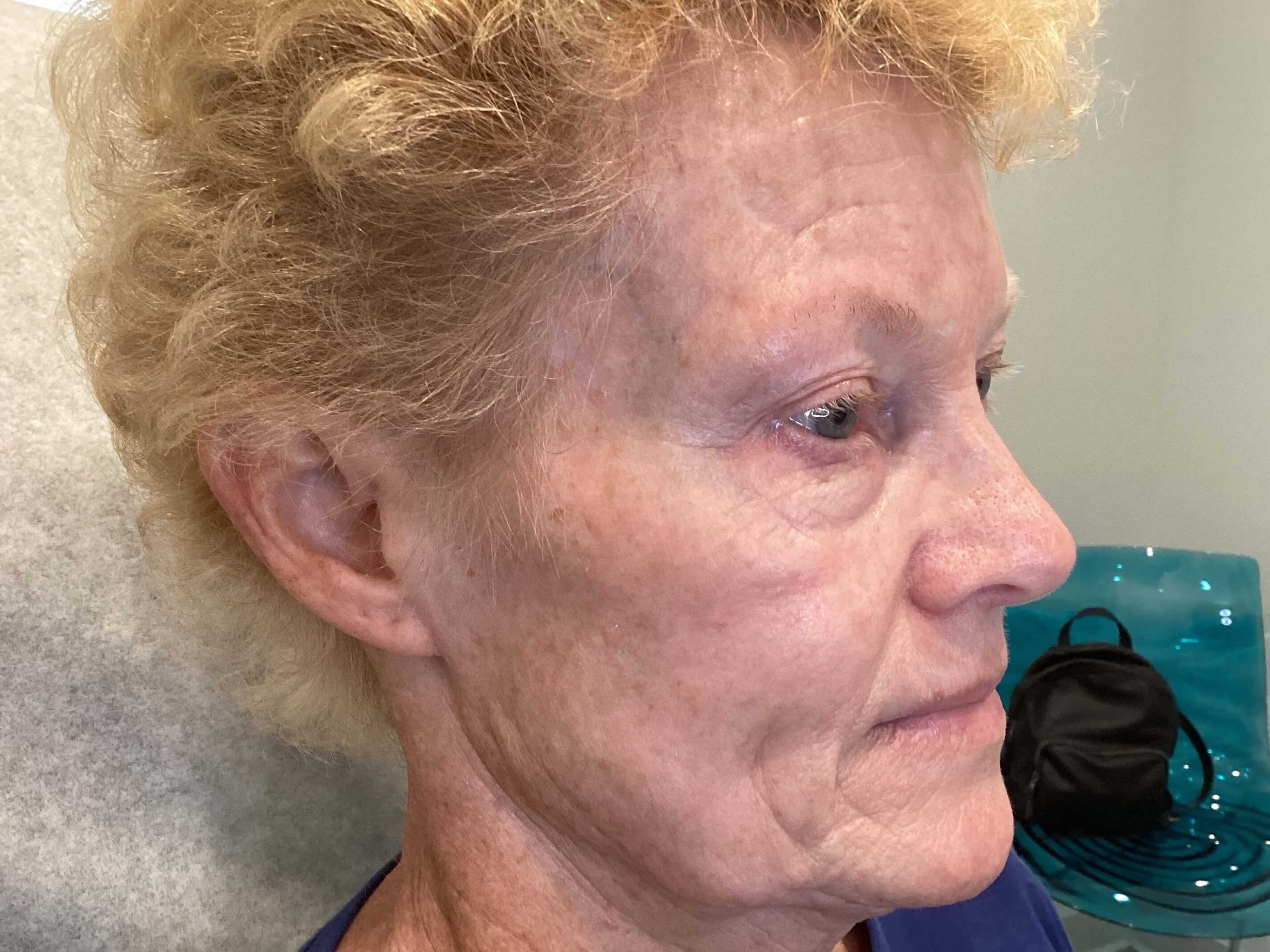 IPL Photofacial After