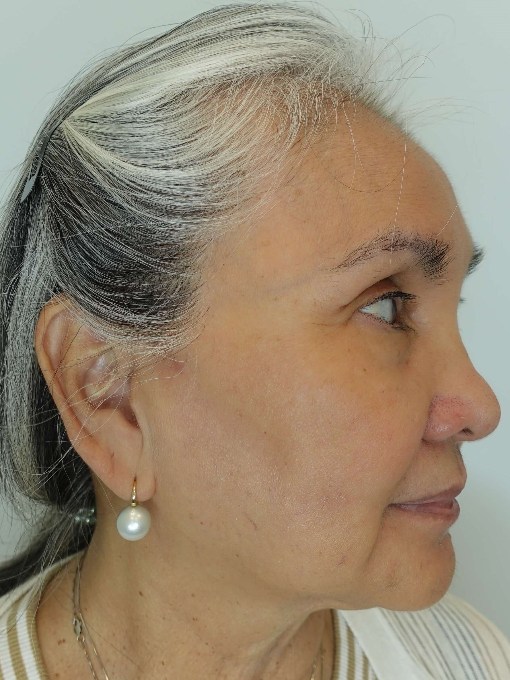 IPL Photofacial After