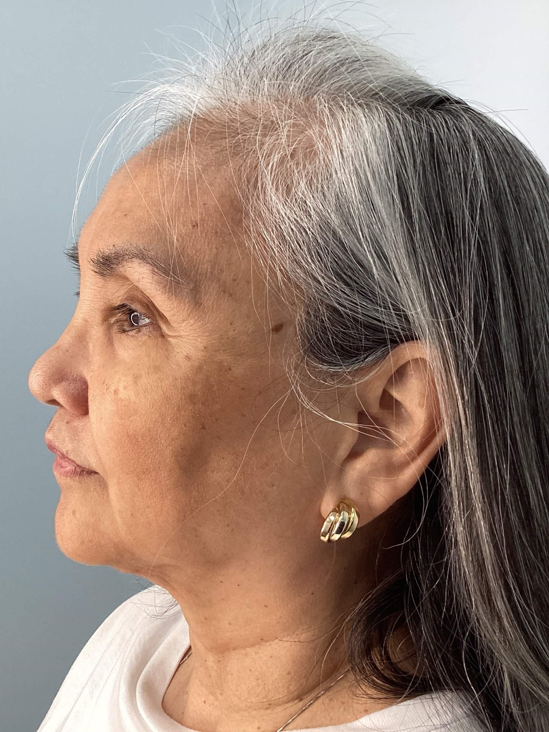 IPL Photofacial Before