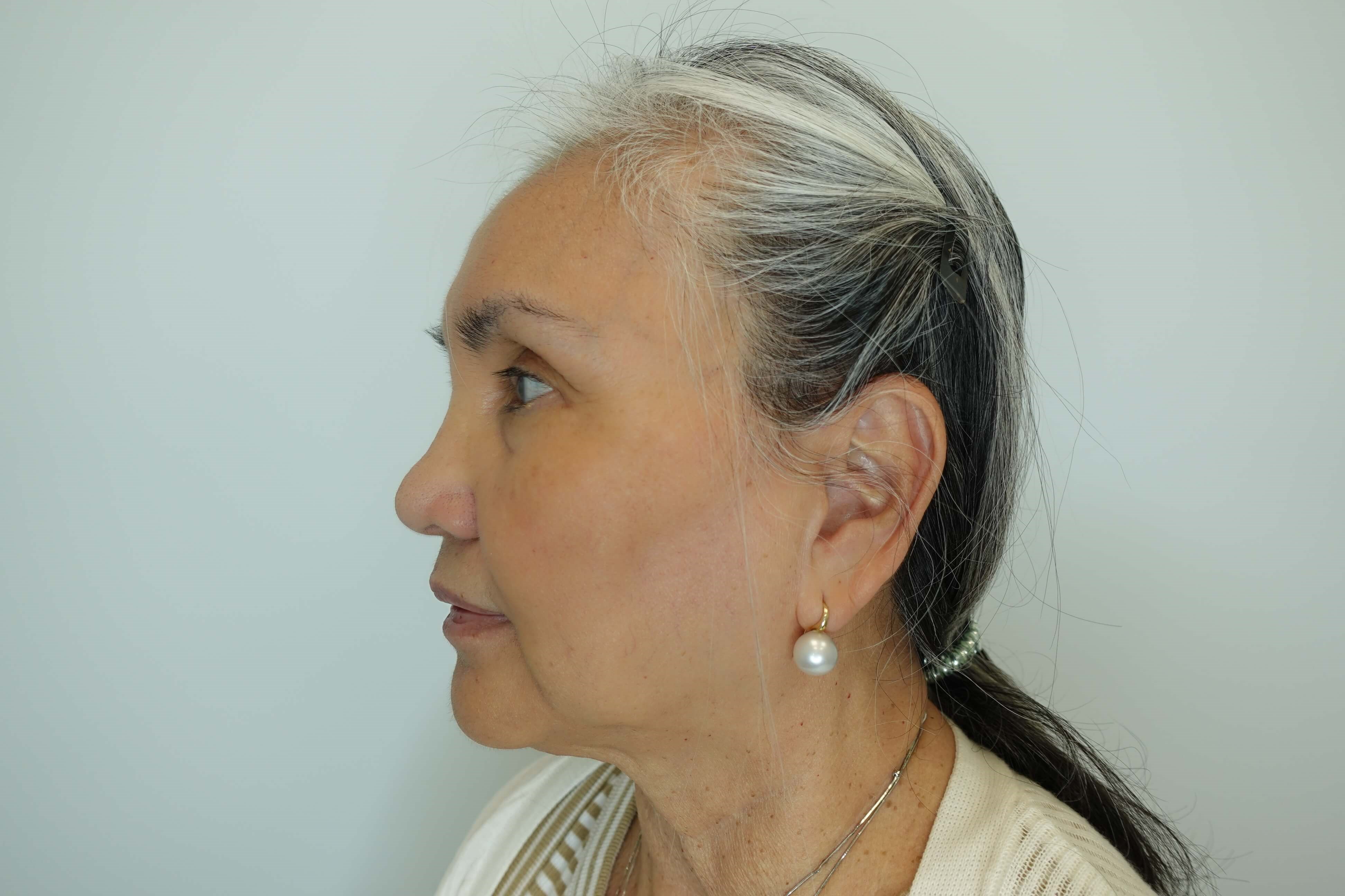 IPL Photofacial After