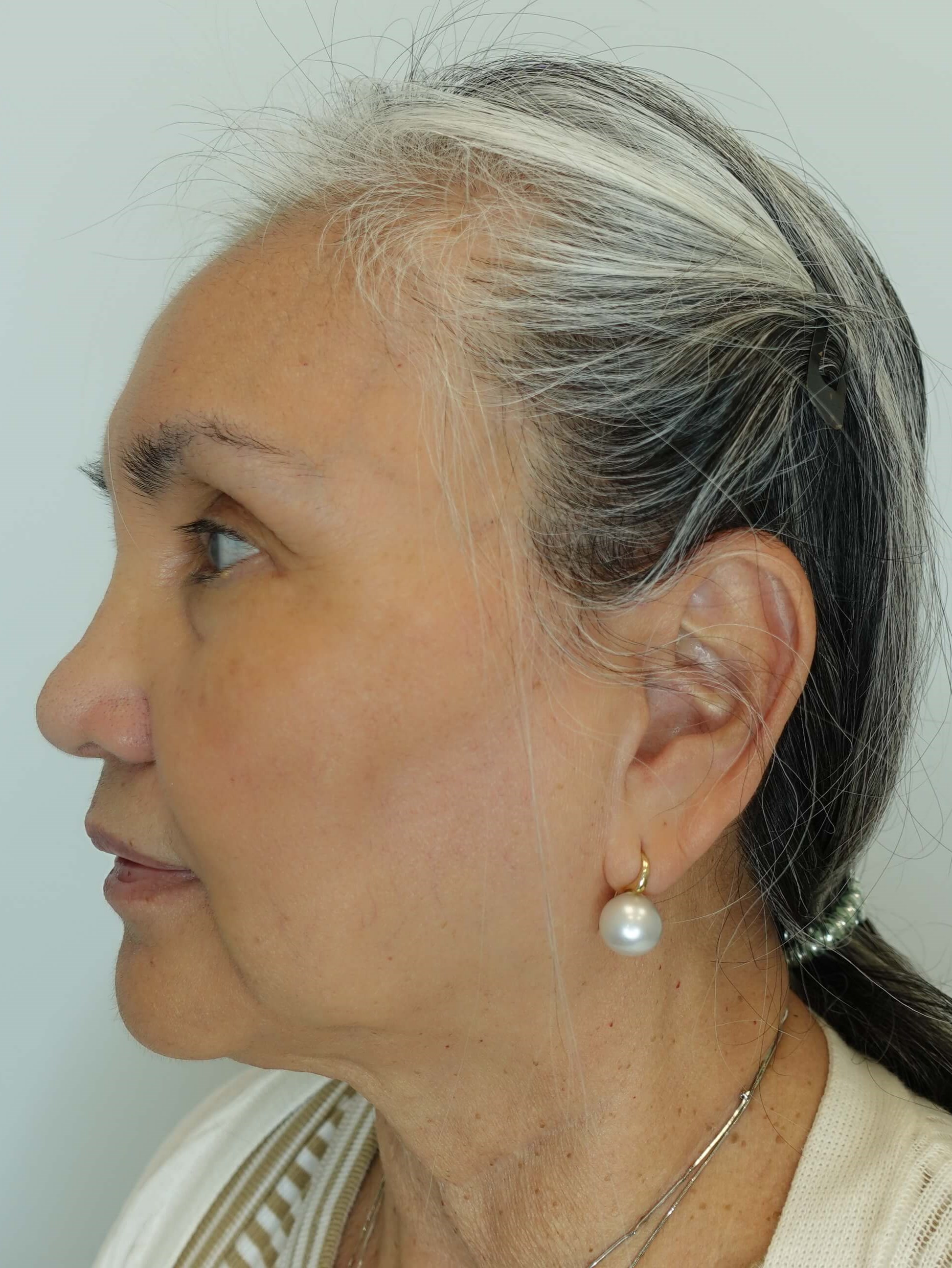 IPL Photofacial After