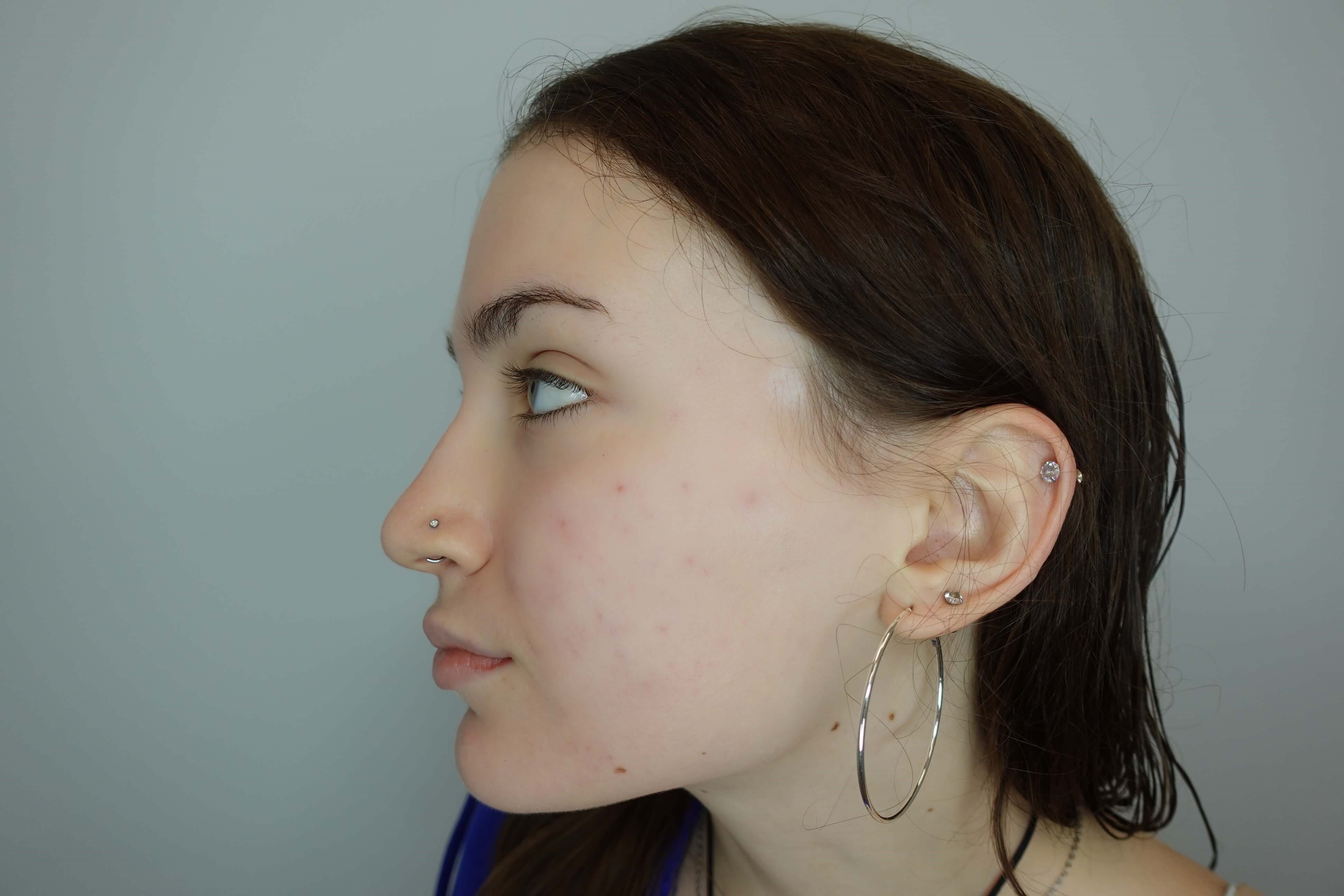 Acne After