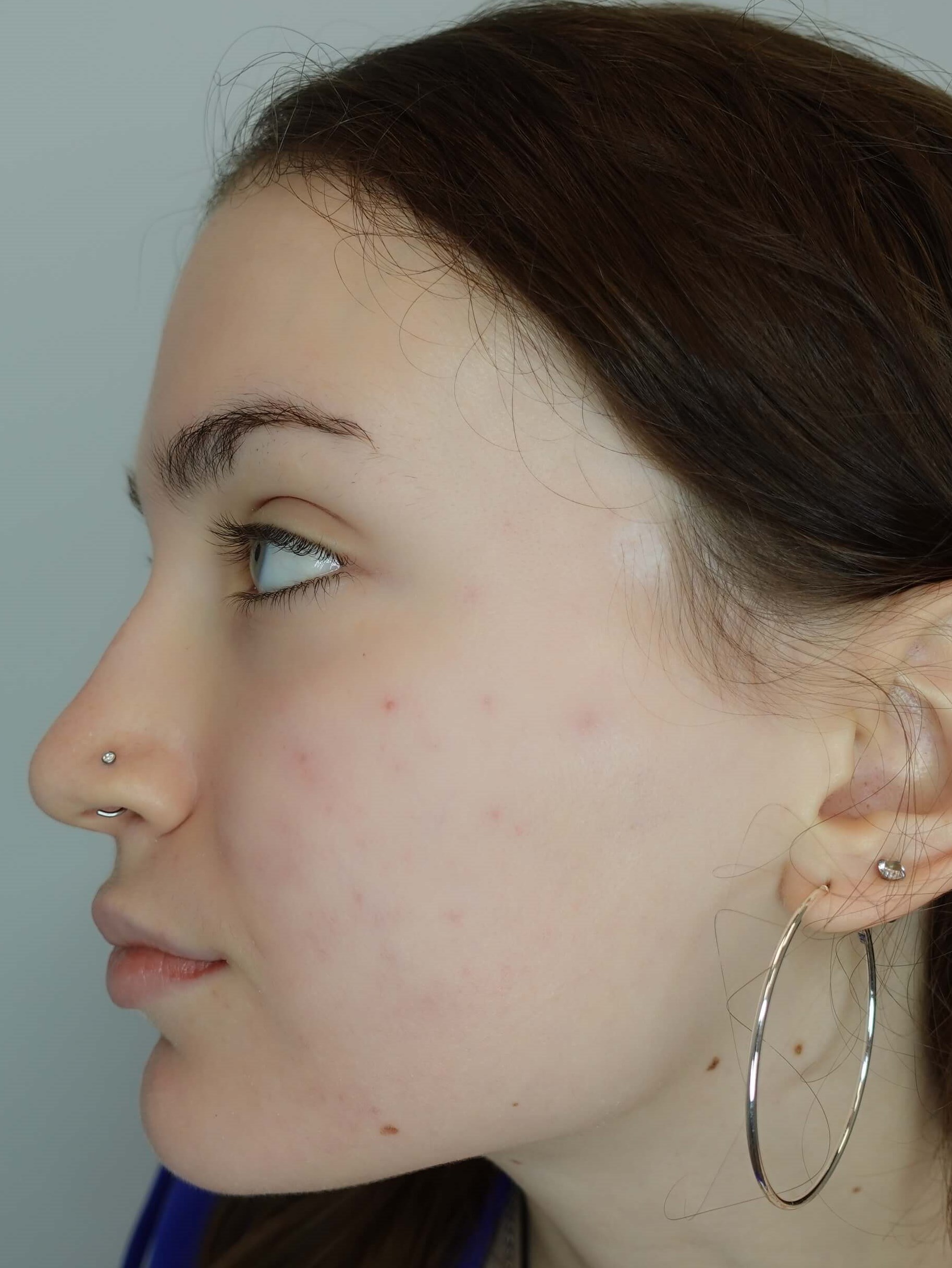 Acne After