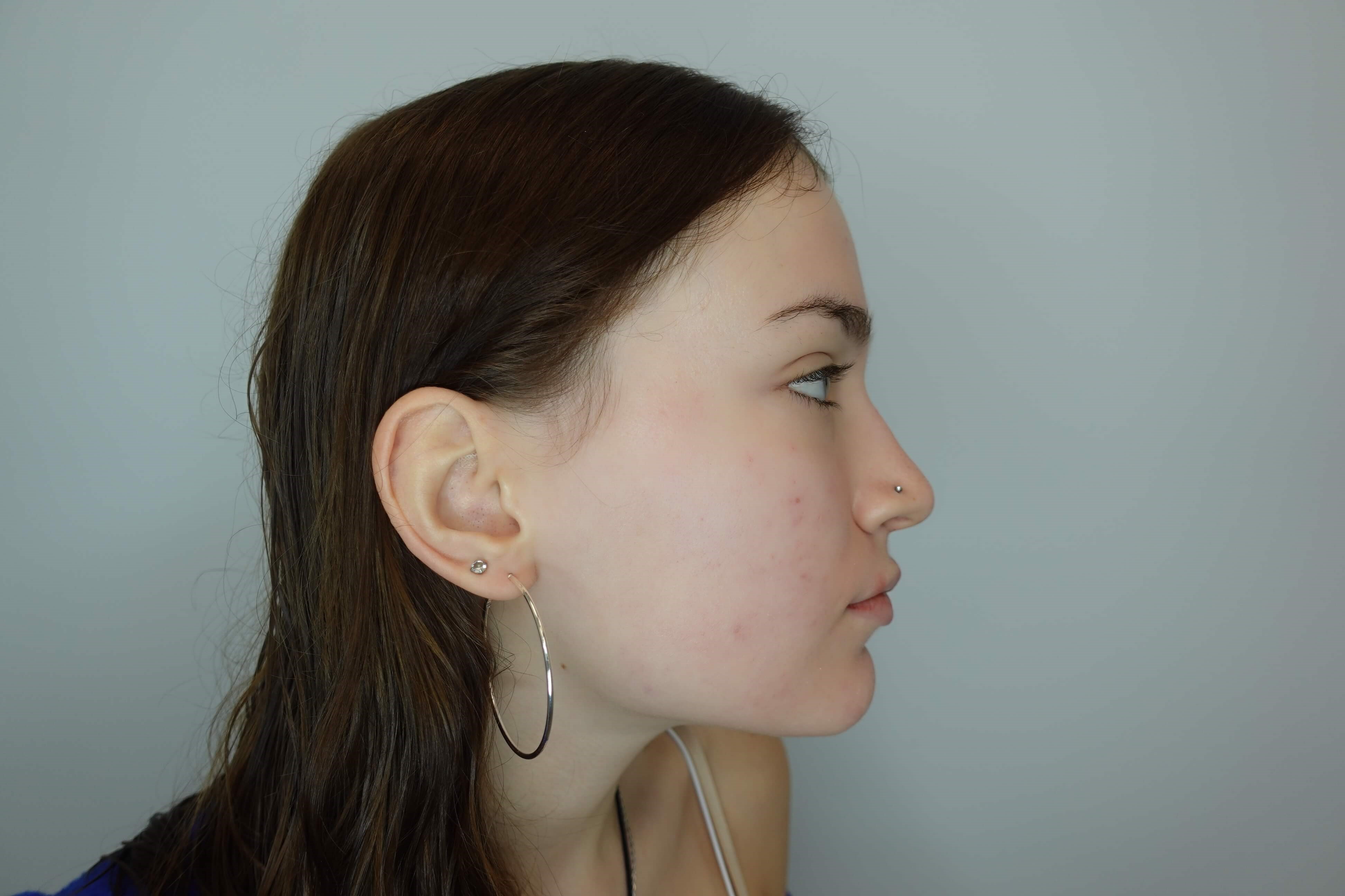 Acne Treatment After