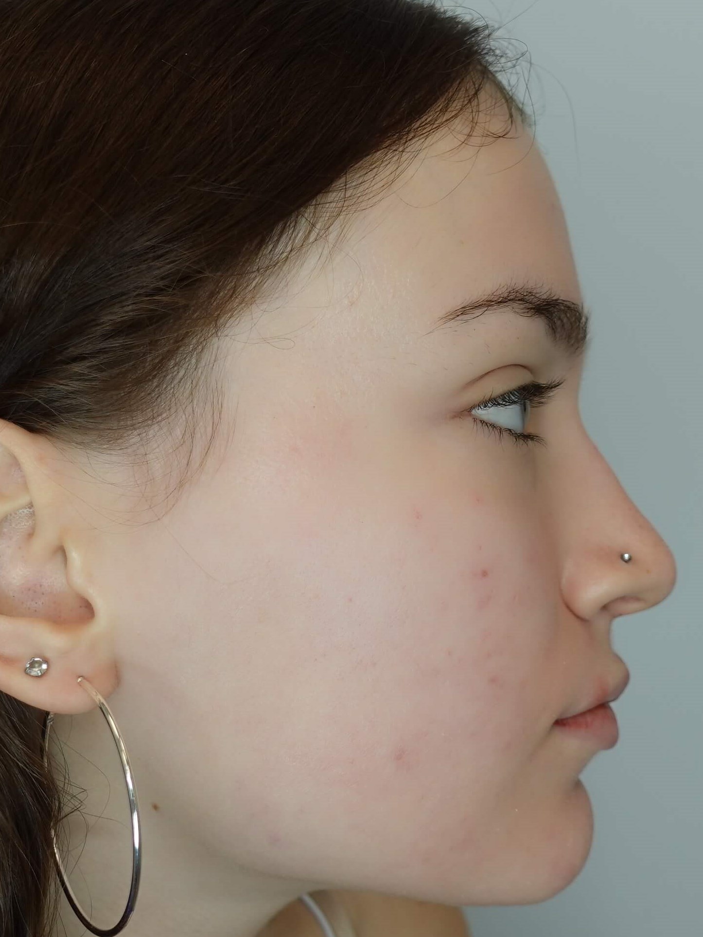 Acne Treatment After