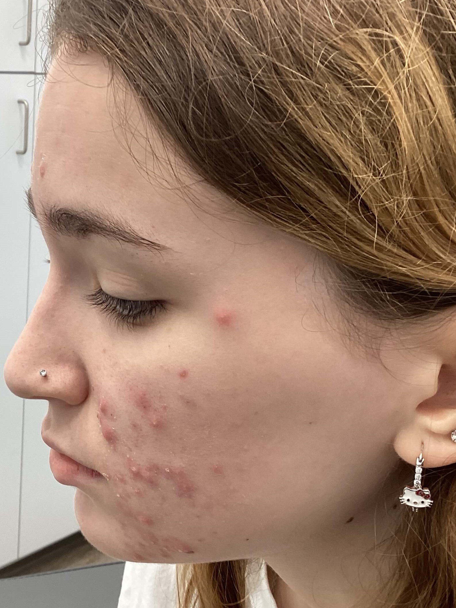 Acne Before