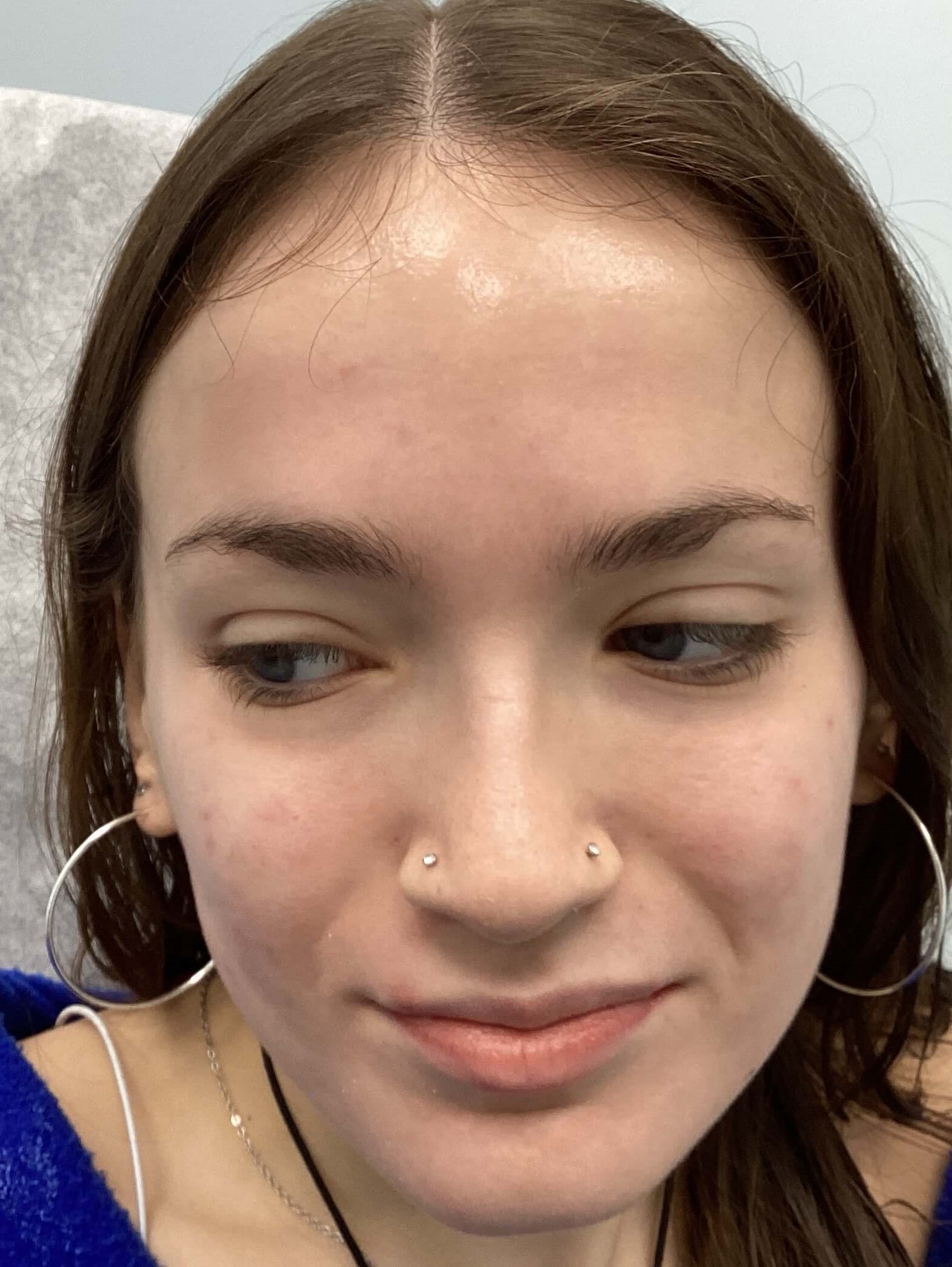 Acne Treatment After