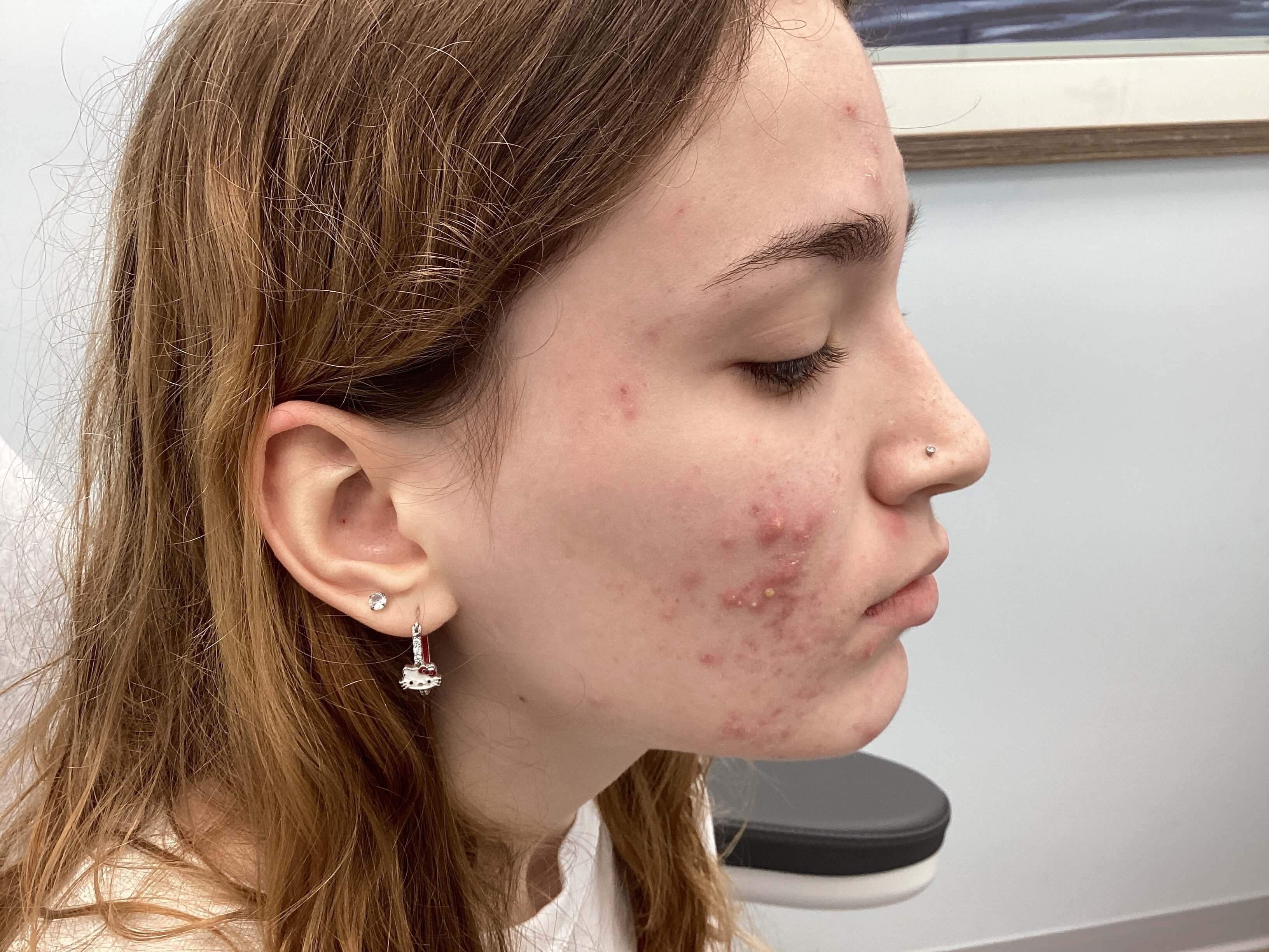 Acne Treatment Before