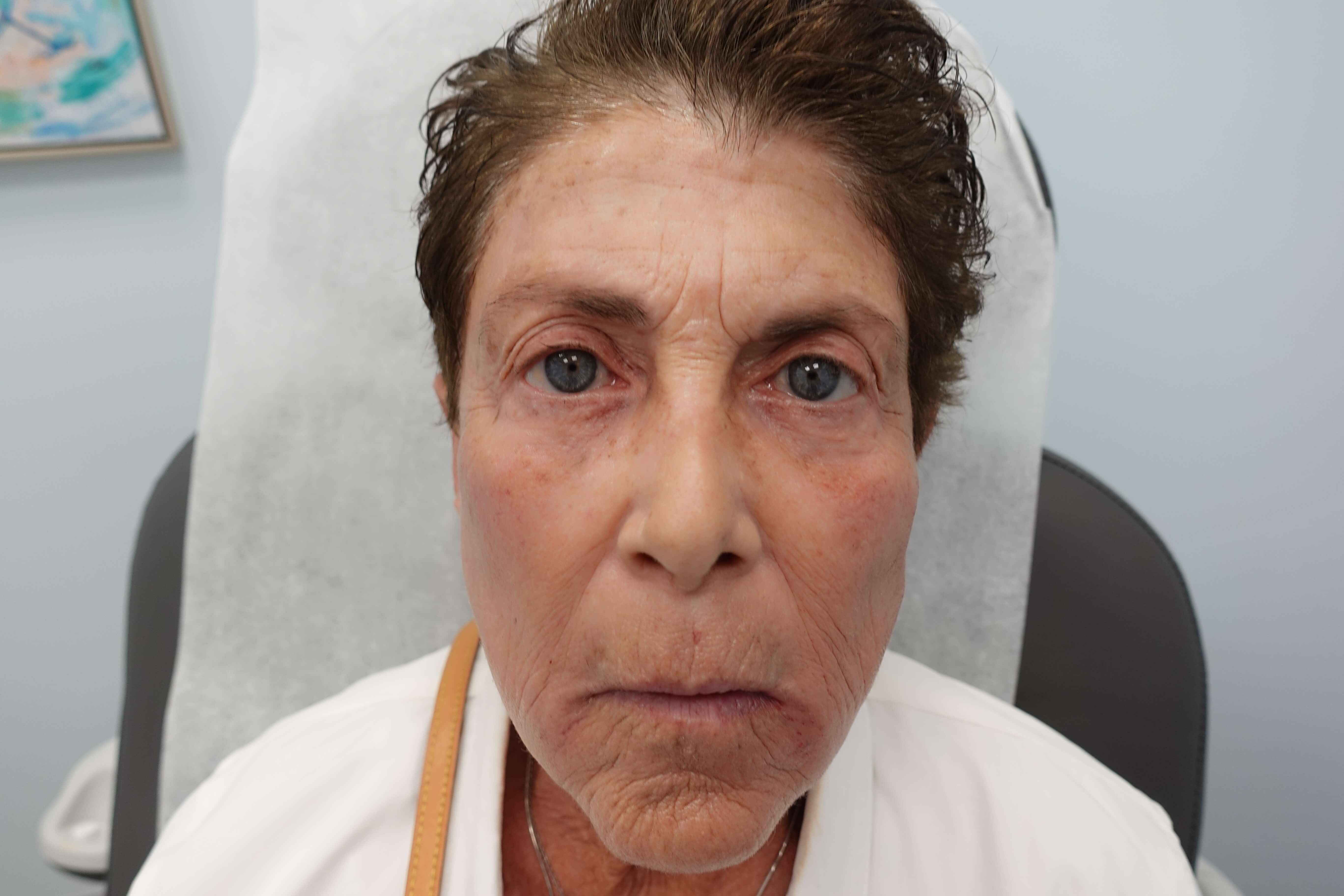 IPL Photofacial After