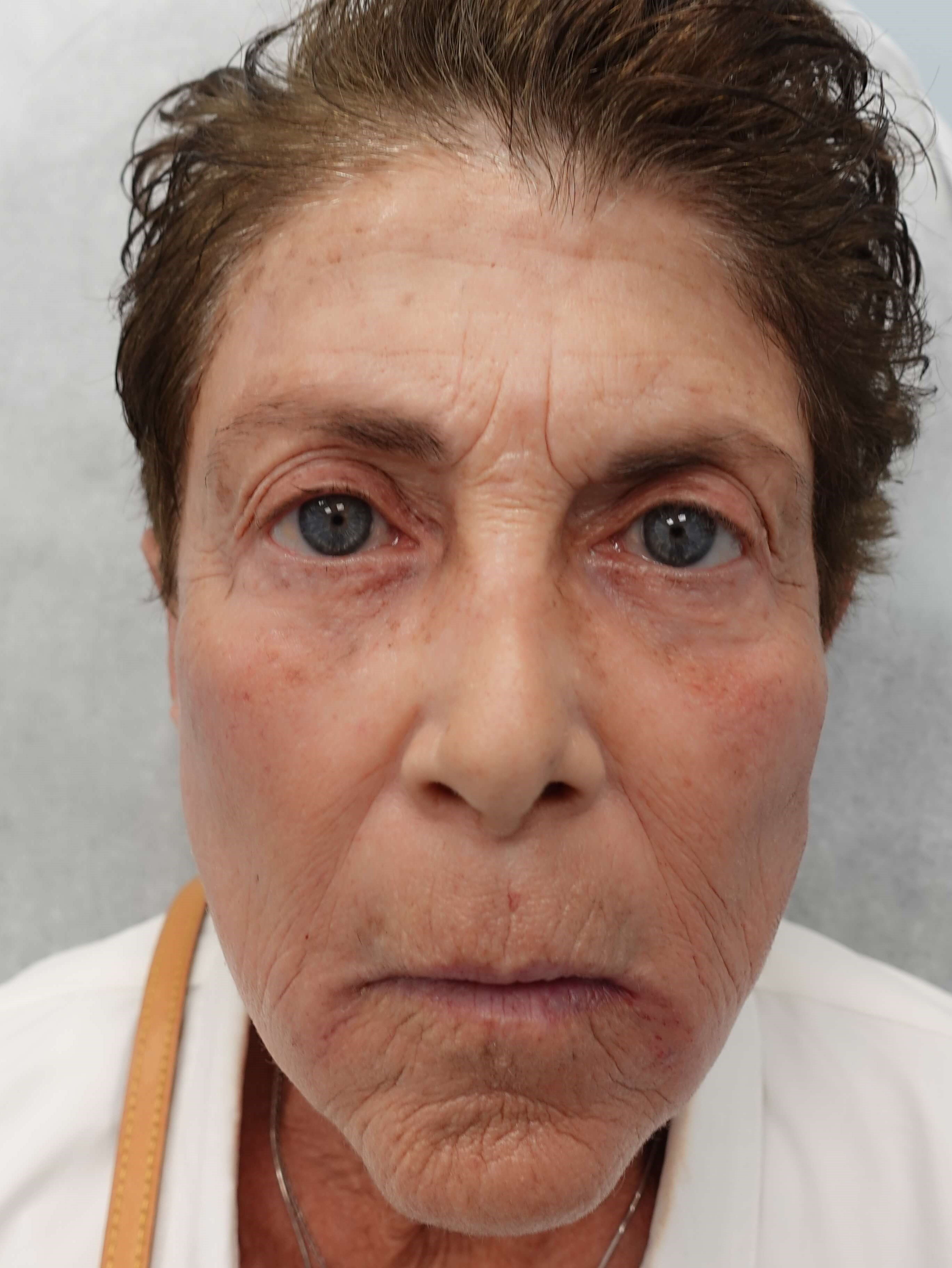 IPL Photofacial After