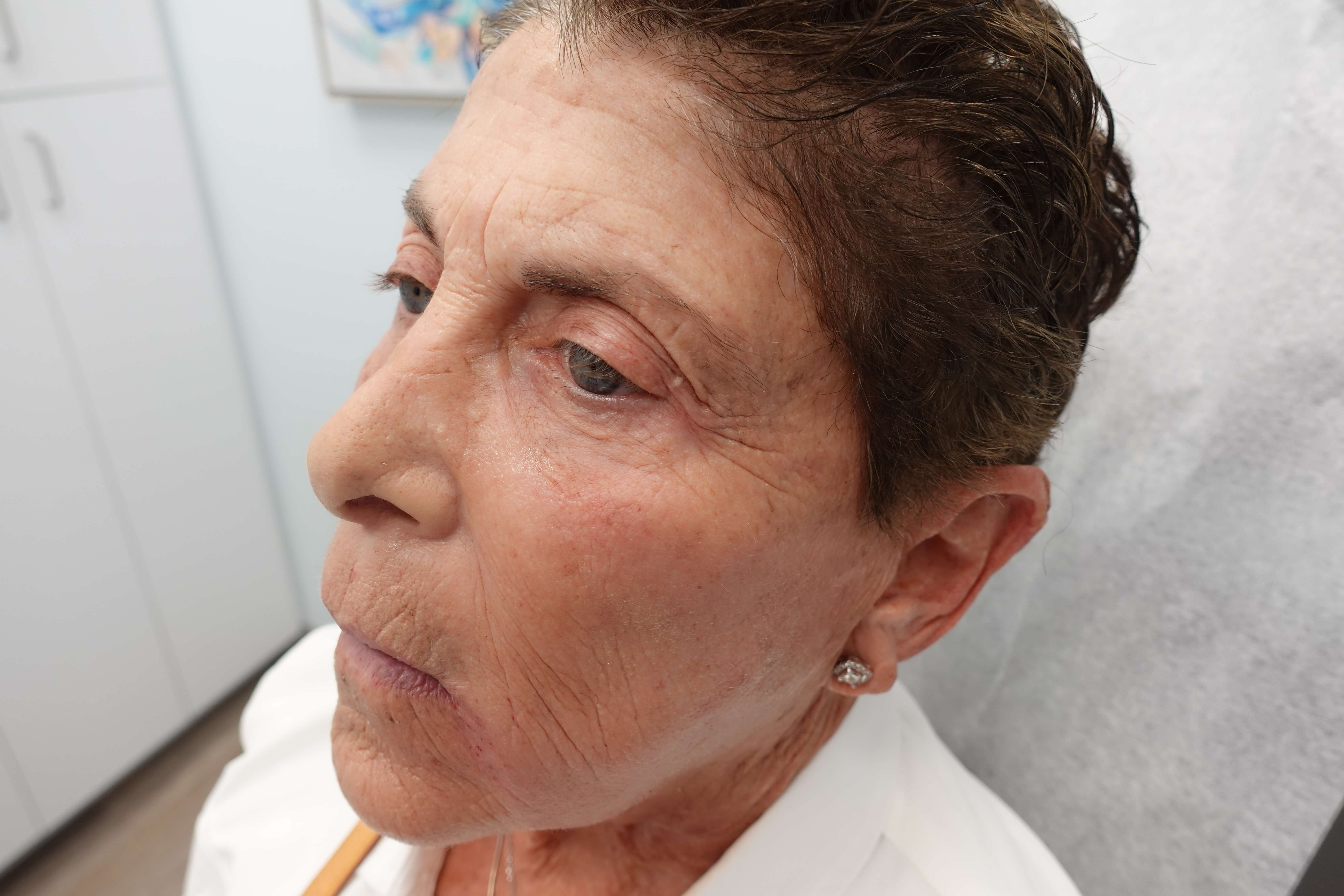 IPL Photofacial After