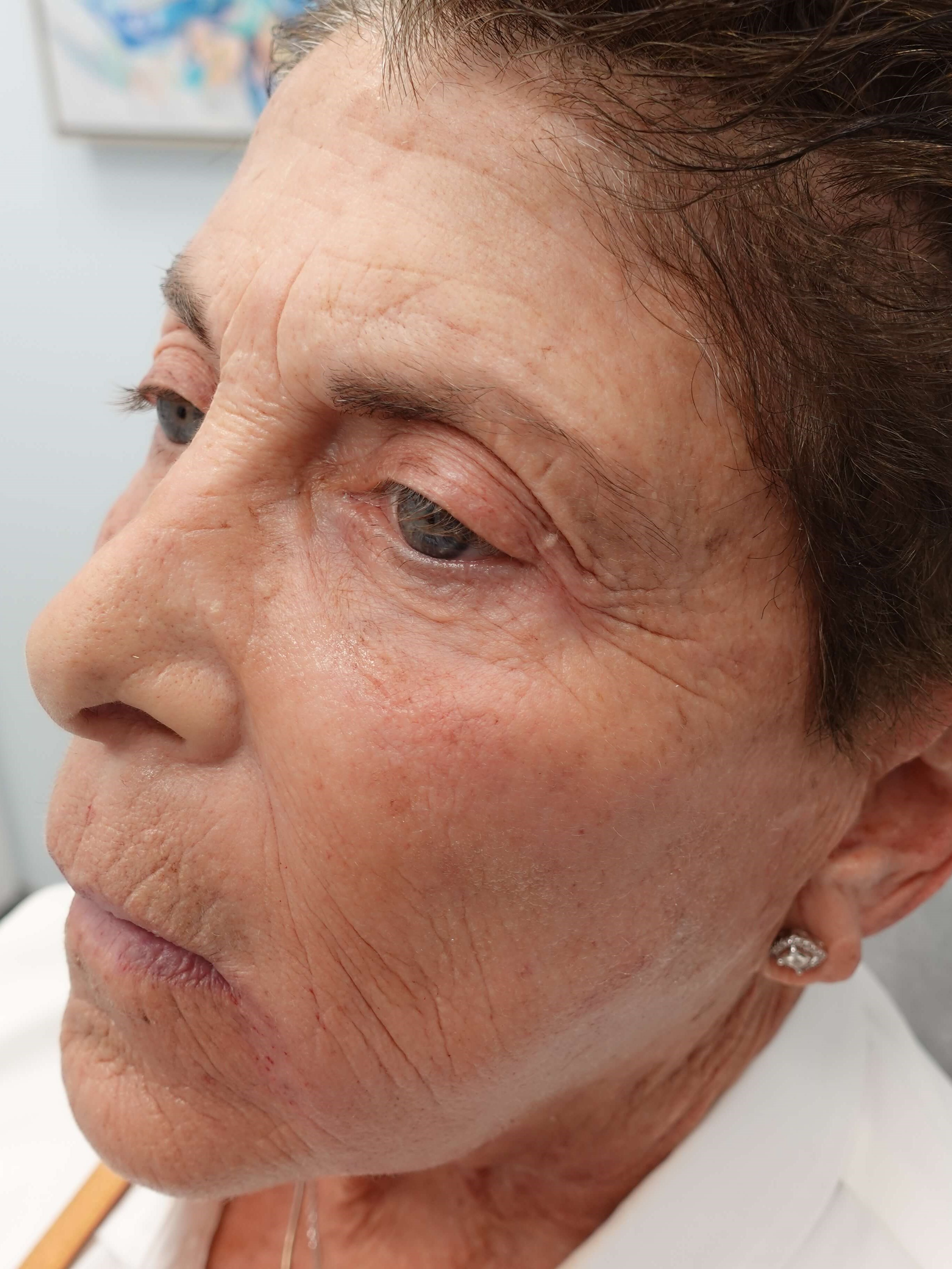 IPL Photofacial After