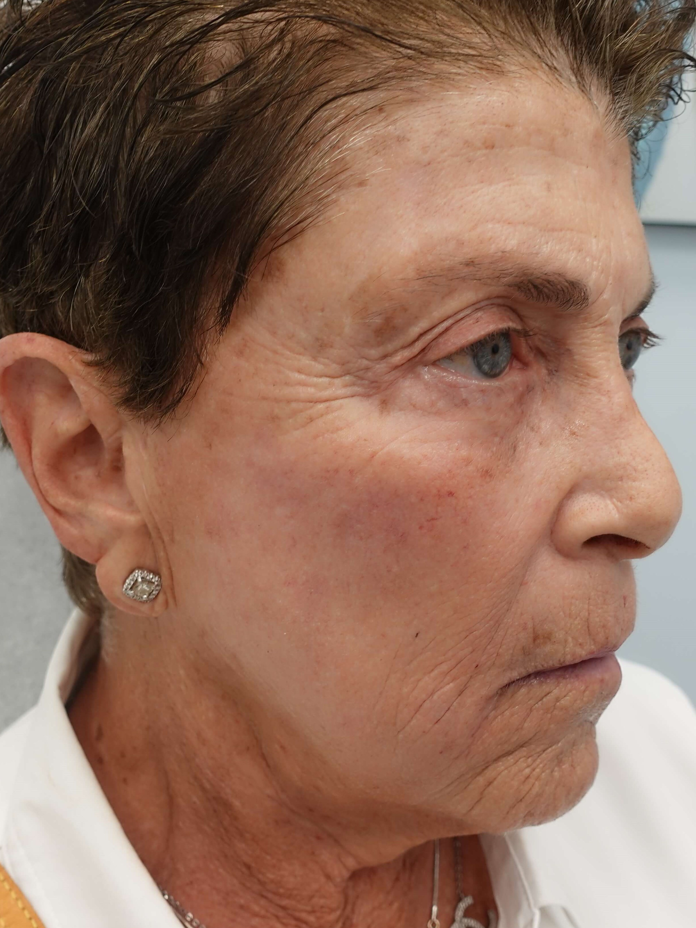 IPL Photofacial After