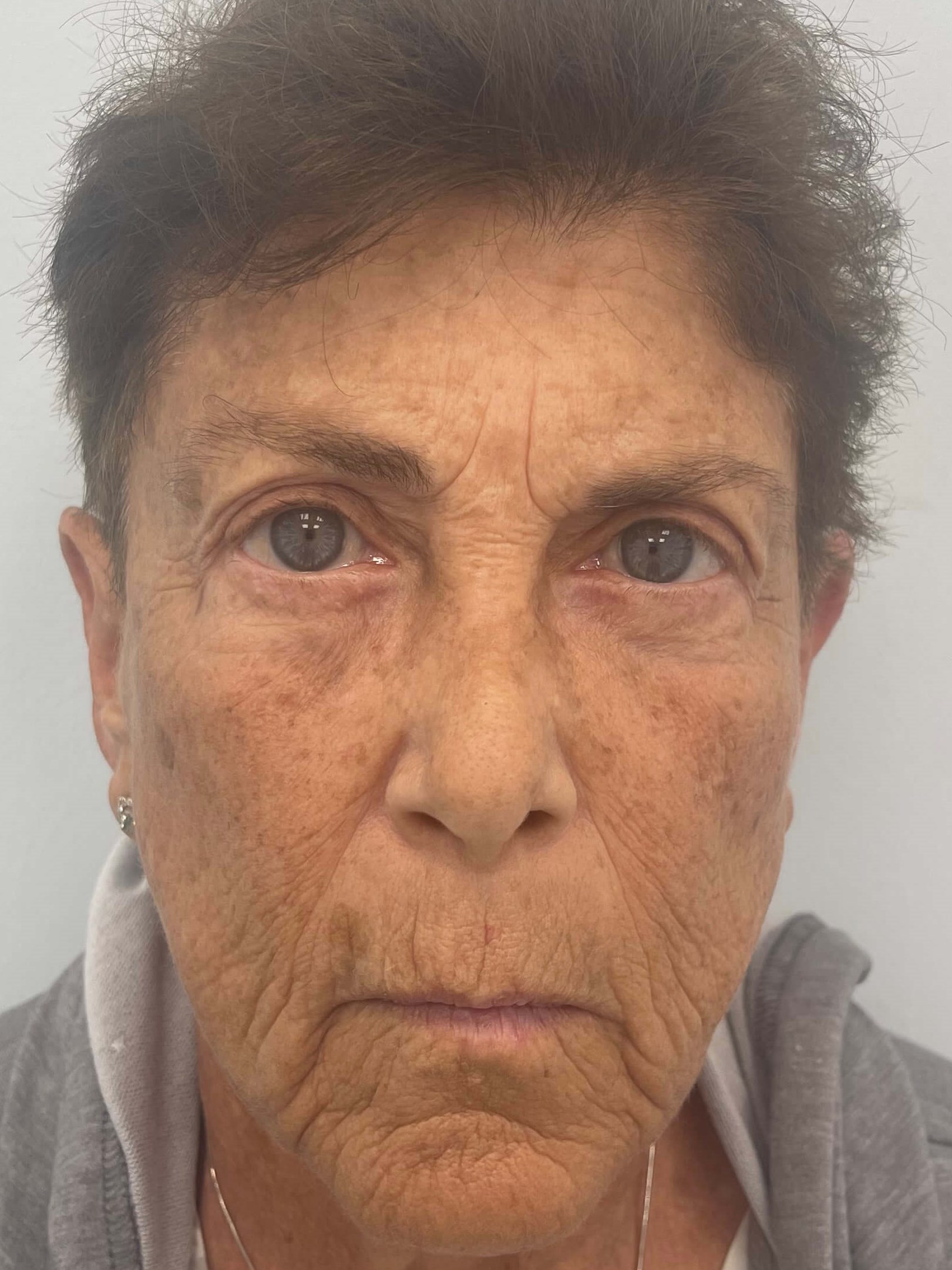 IPL Photofacial Before