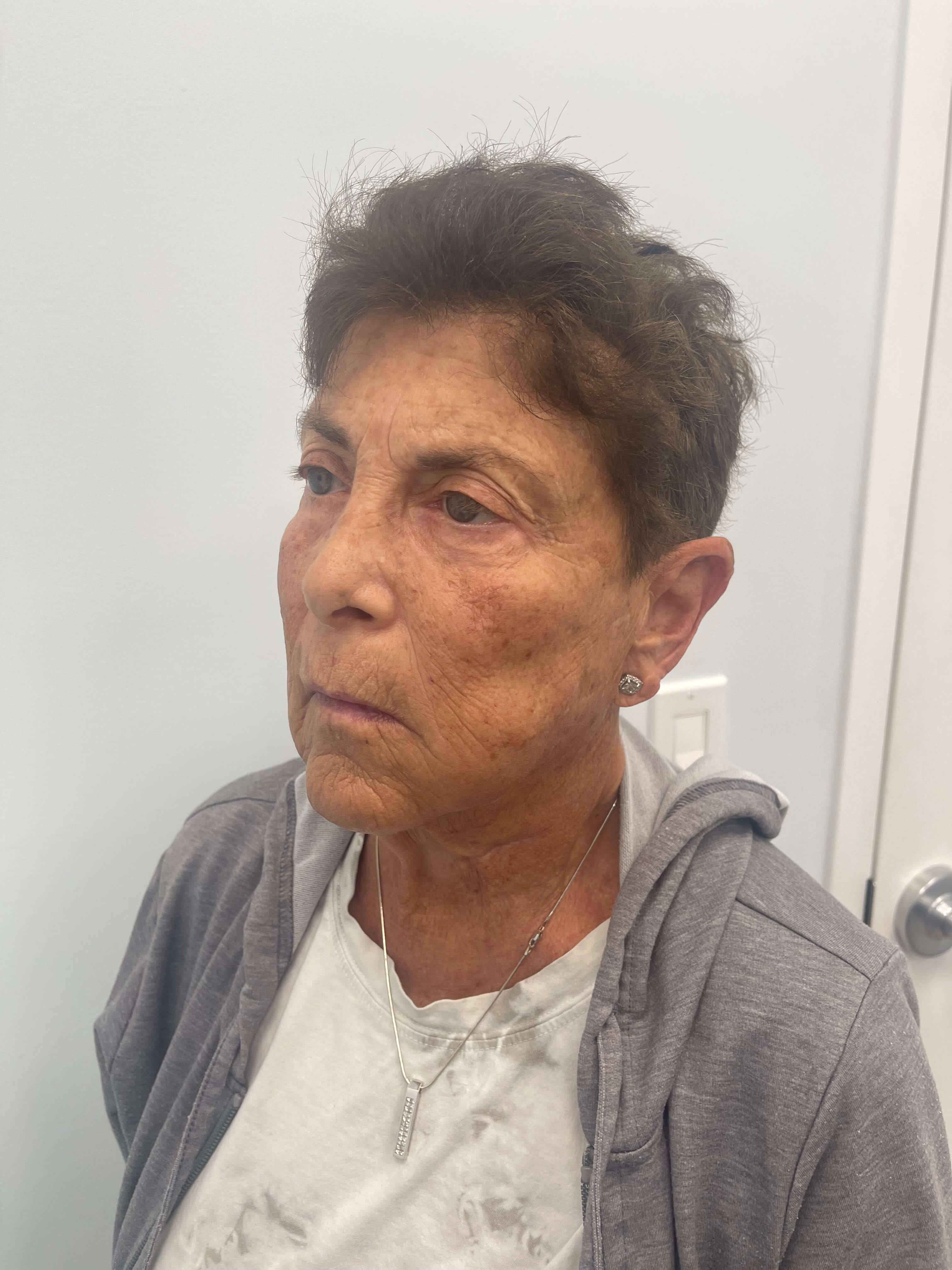 IPL Photofacial Before