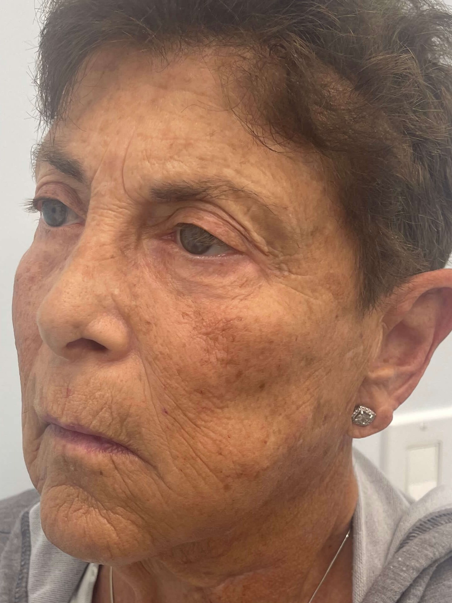 IPL Photofacial Before
