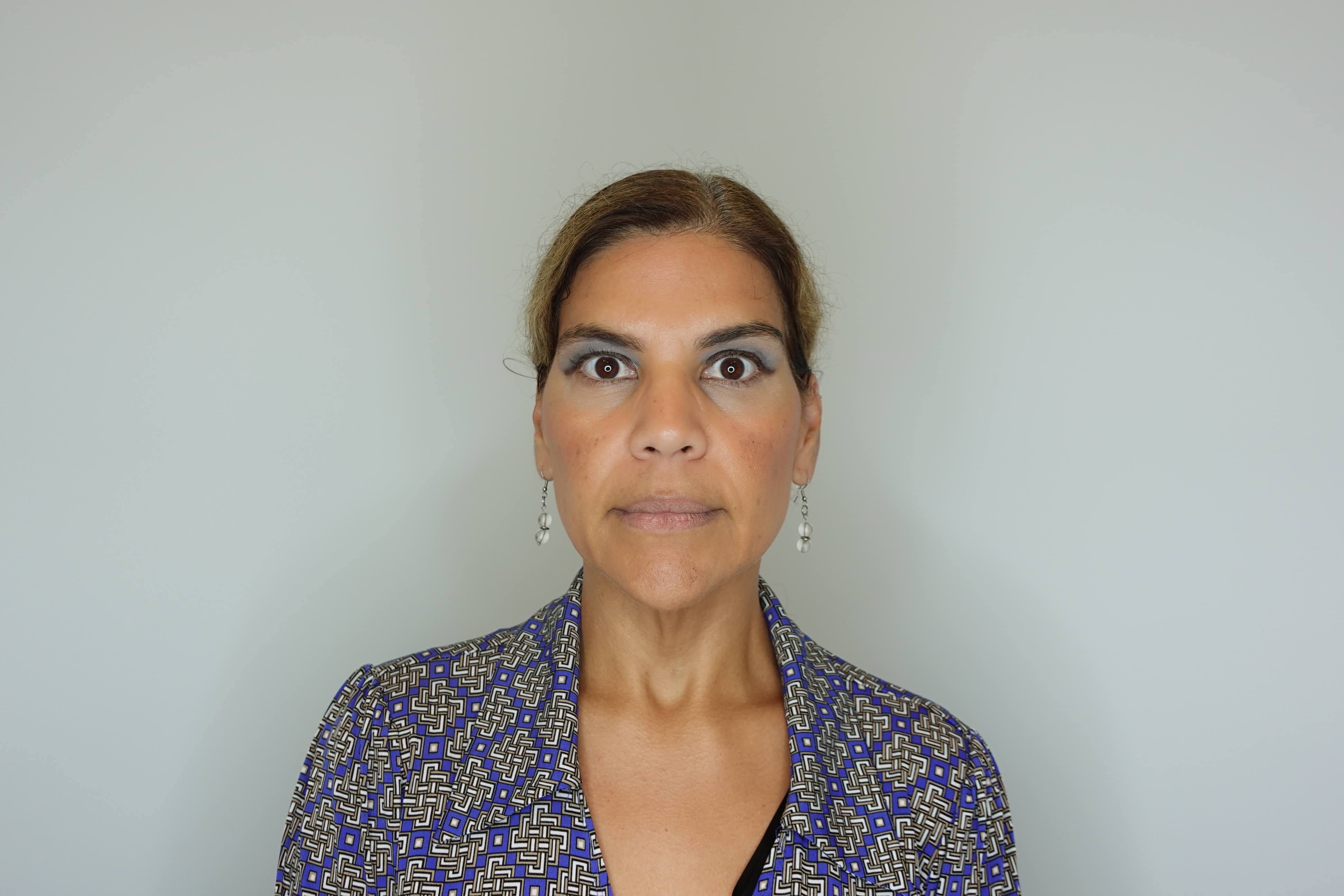 Dysport (Wrinkle Relaxer) After