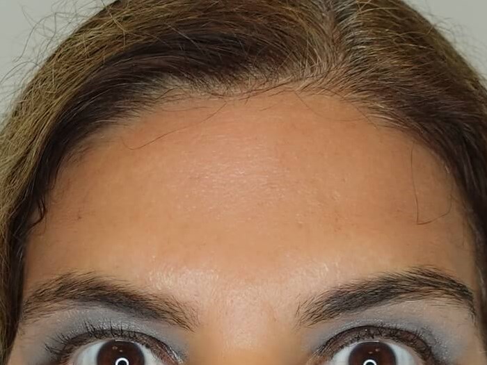 Dysport (Wrinkle Relaxer) After