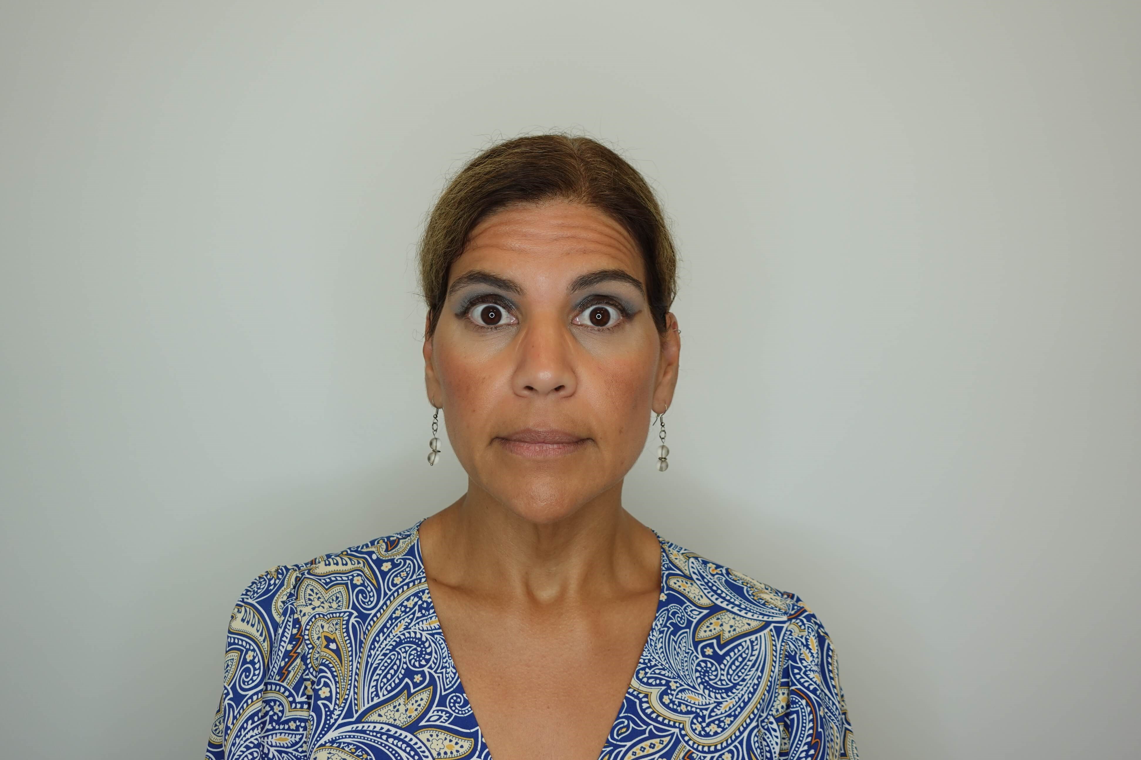 Dysport (Wrinkle Relaxer) Before