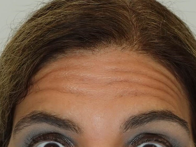 Dysport (Wrinkle Relaxer) Before