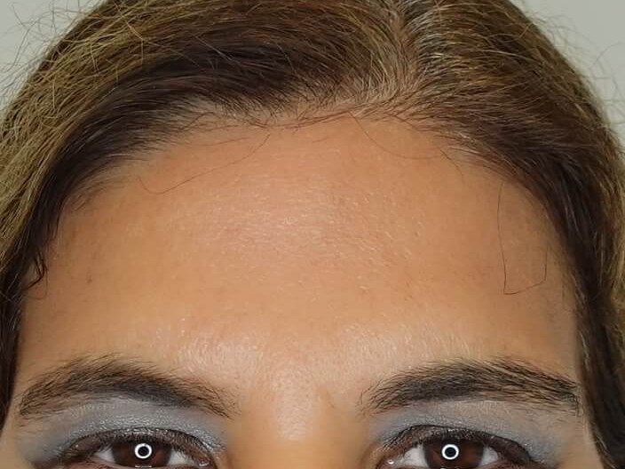 Dysport (Wrinkle Relaxer) After