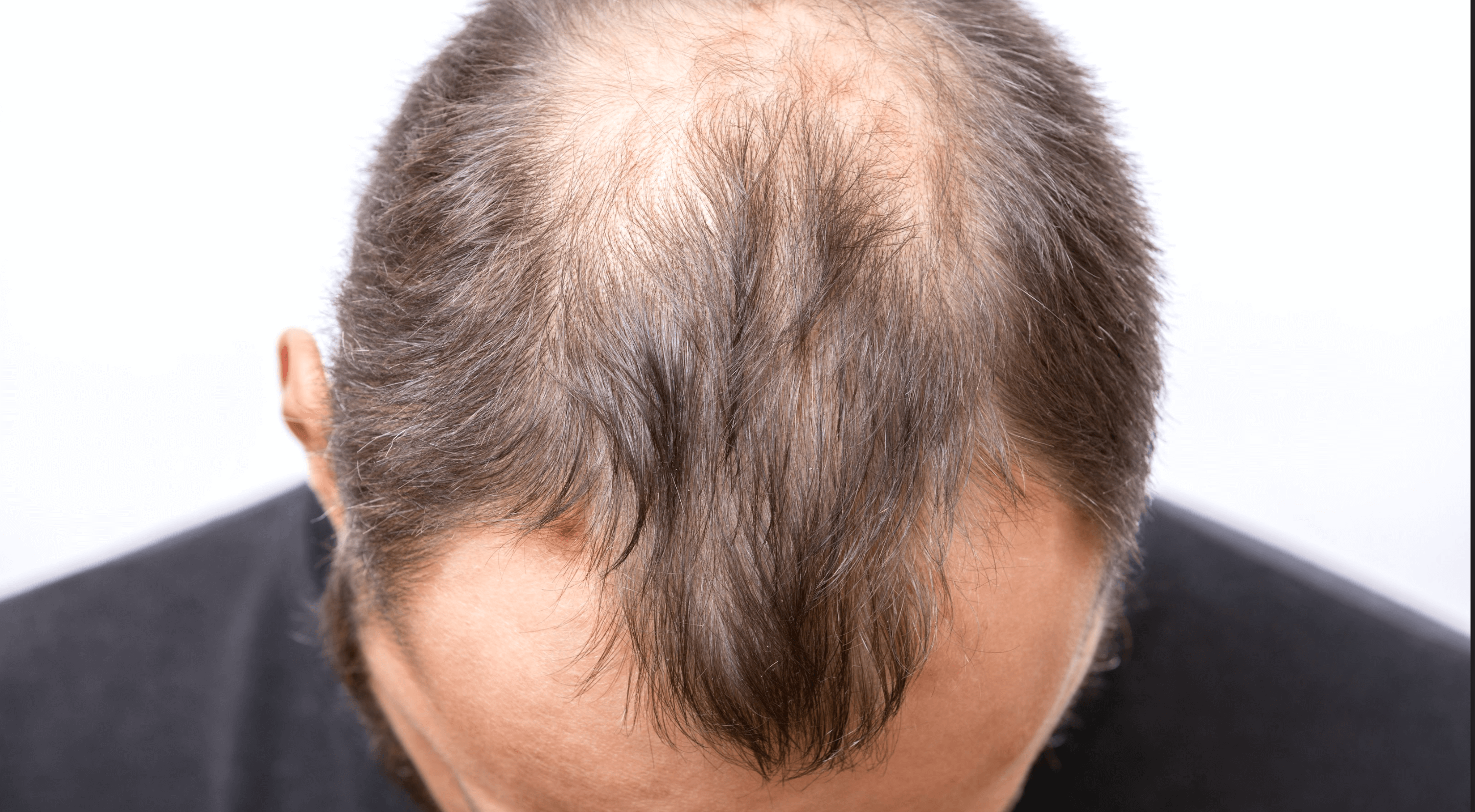 How To Grow Hair On Bald Spot  Treatments And Prevention Tips