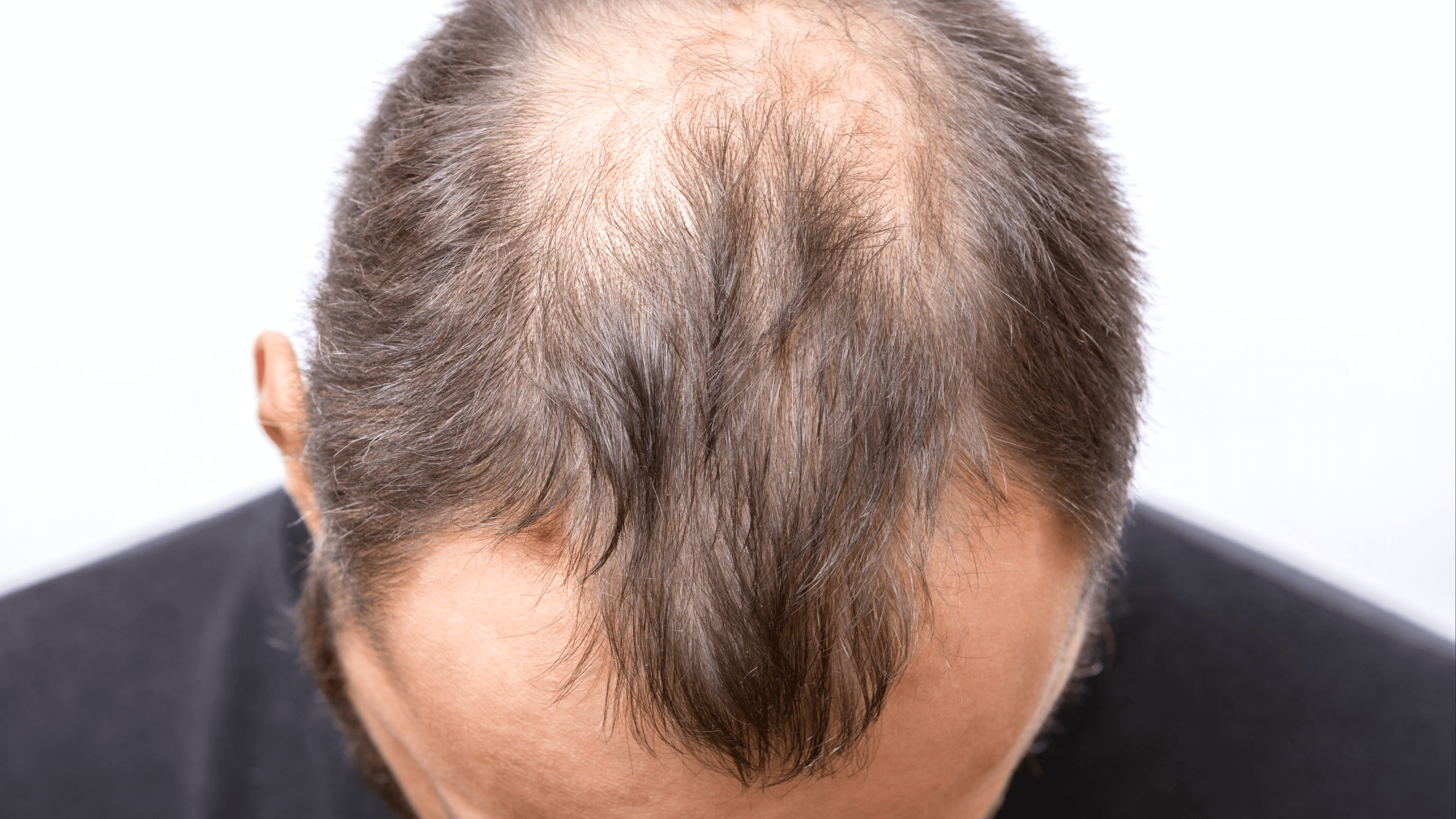 Is It Possible To Regrow Hair On My Bald Spots?